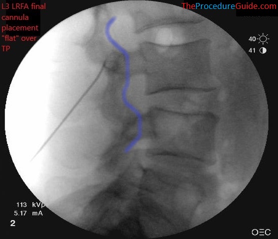 Fluoroscopic Guided Thoracic Lumbar Interlaminar Epidural Steroid Injection Technique And