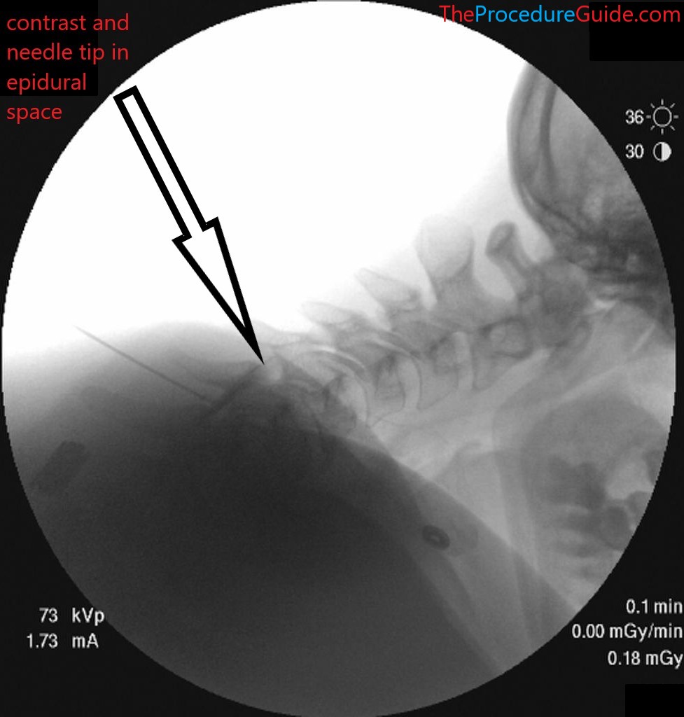 cervical epidural steroid injection fluoroscopy lateral