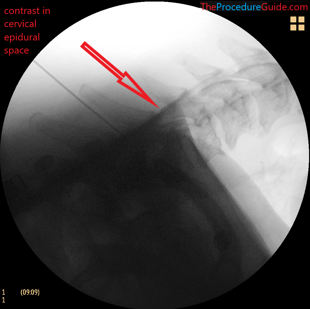 cervical epidural steroid injection fluoroscopy lateral