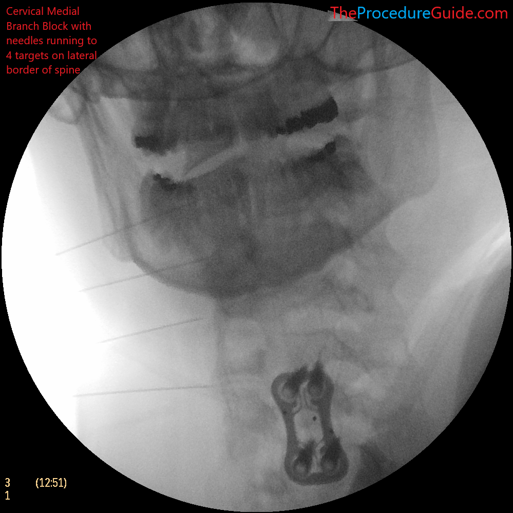 cervical medial branch block AP fluoroscopy