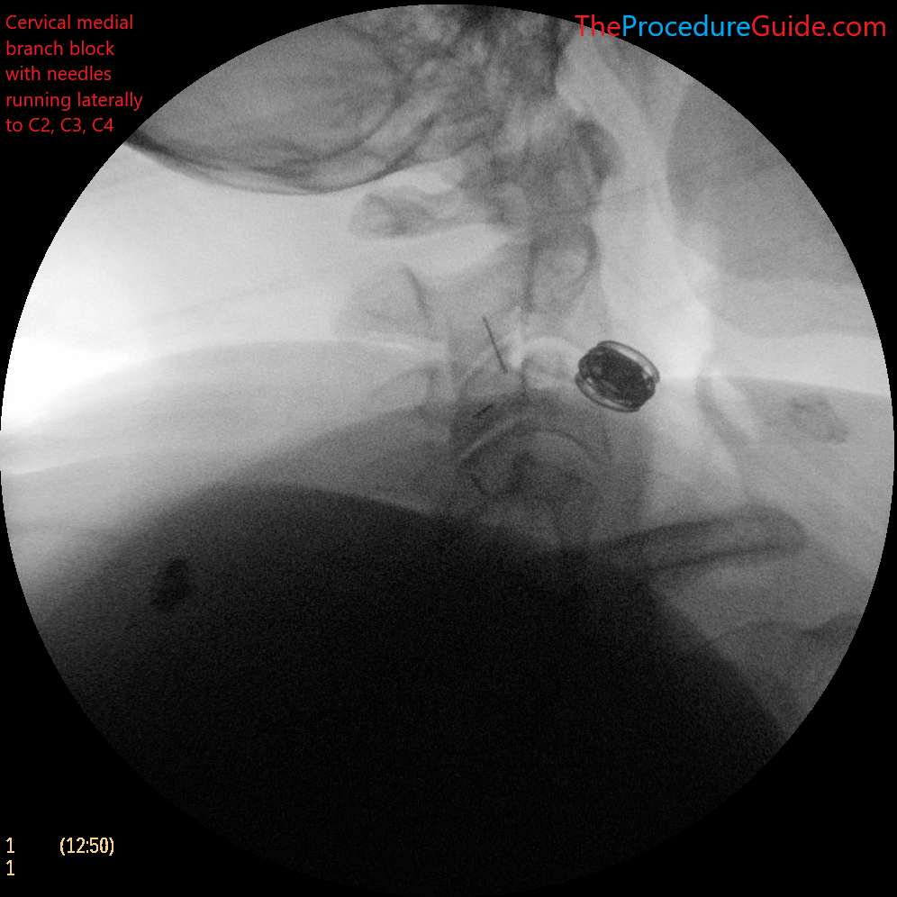 cervical medial branch block Lateral fluoroscopy