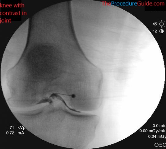 knee with contrast spread in joint