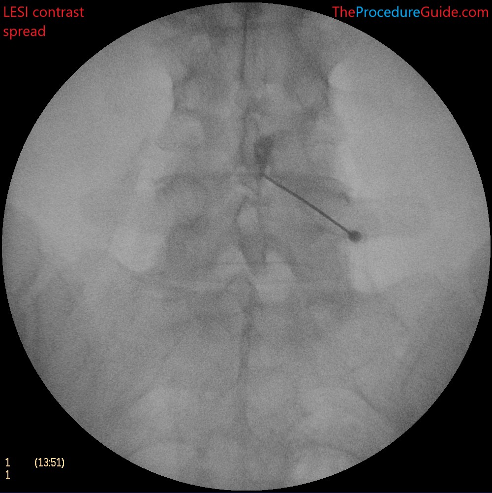 lumbar epidural steroid injection AP fluoroscopy contrast