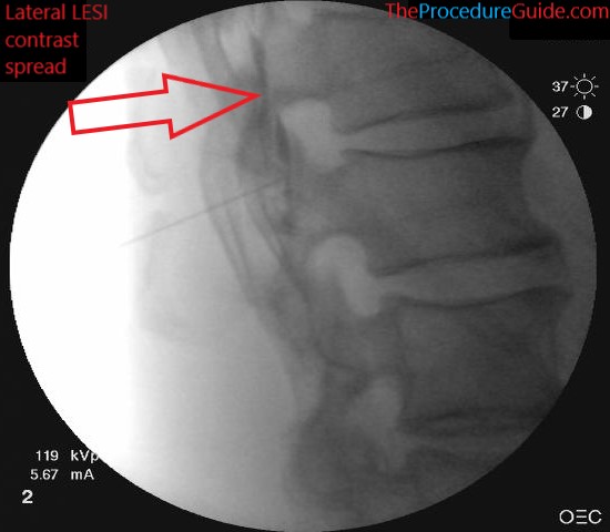 Fluoroscopic Guided Thoracic Lumbar Interlaminar Epidural Steroid Injection Technique And