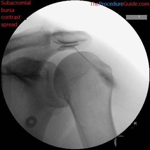 Fluoroscopic Guided Shoulder Subacromial Bursa Sab Injection Technique And Overview The