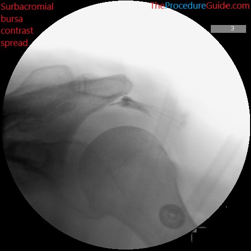 Fluoroscopic Guided Shoulder Subacromial Bursa Sab Injection Technique And Overview The