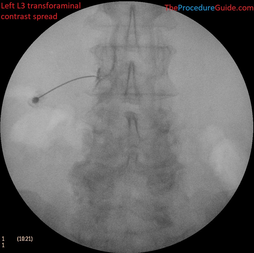 L3-transforaminal-epidural-steroid-injection-fluoroscopy-AP