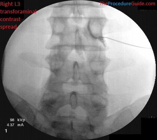 Fluoroscopic Guided Thoracic Lumbar Transforaminal Epidural Steroid Injection Technique And