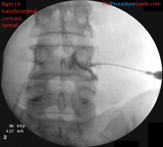 L4-transforaminal-epidural-steroid-injection-fluoroscopy-AP