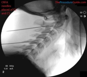 Fluoroscopic Guided Cervical Medial Branch Radiofrequency Ablation ...