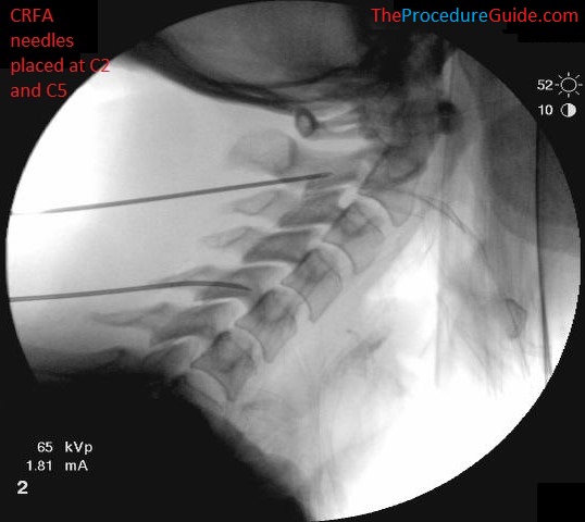 Cervical Medial Branch Block