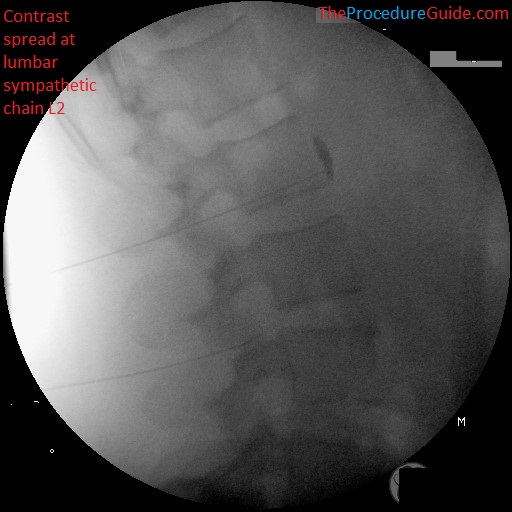 lateral fluoroscopy with contrast lumbar sympathetic block