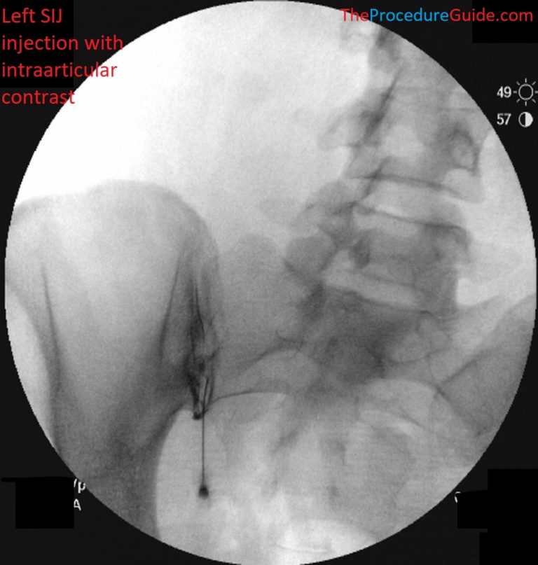 Fluoroscopic Guided Sacroiliac (SIJ) Joint Injection – Technique and ...