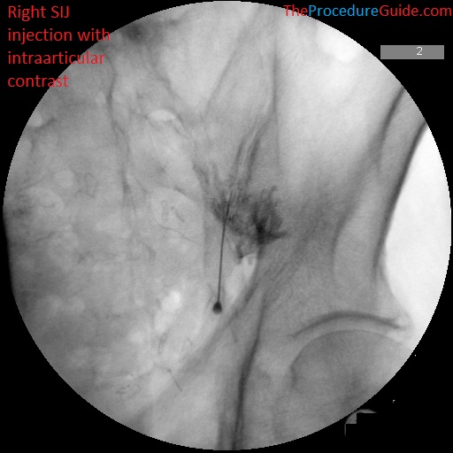 sacroiliac joint injection