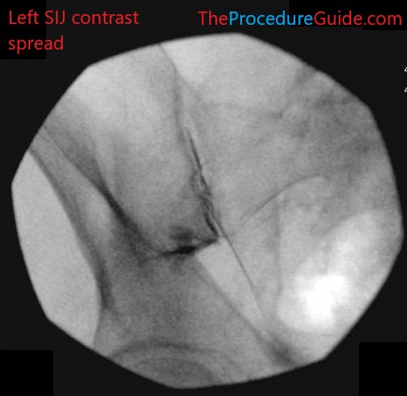 sacroiliac joint injection technique