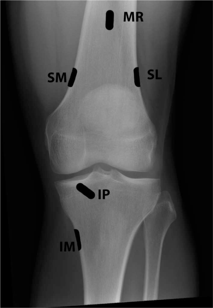 fluoroscopic-guided-knee-genicular-nerve-block-technique-and-overview