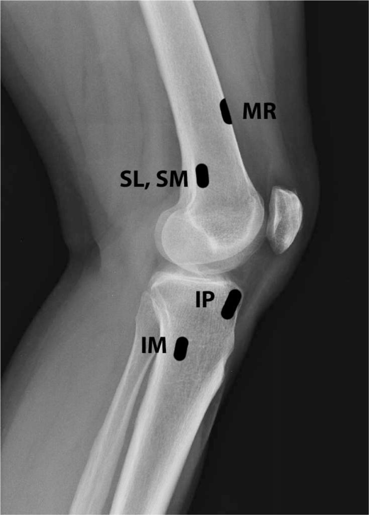 genicular nerve anatomical locations lateral xray labeled