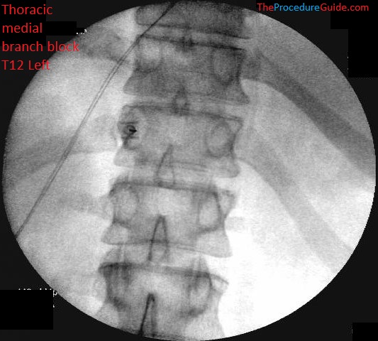 Thoracic Medial Branch Block