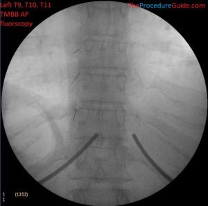 Fluoroscopic Guided Thoracic Medial Branch Block - Technique and ...