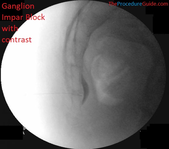 ganglion impar block lateral fluoroscopy