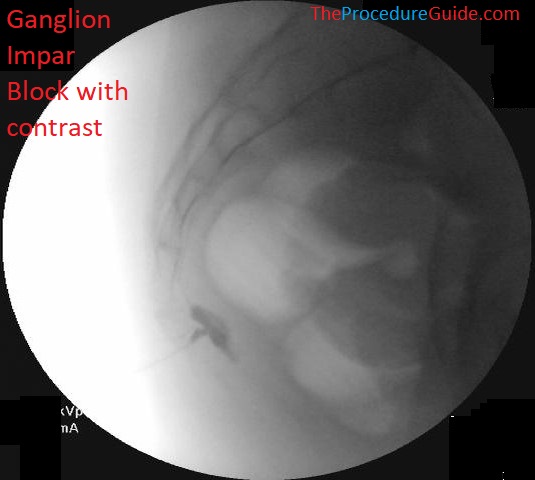 ganglion impar block lateral fluoroscopy