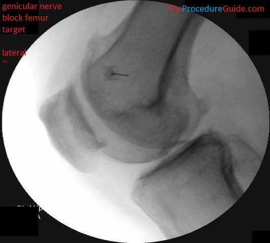 genicular nerve block lateral fluoroscopy with needle femur target