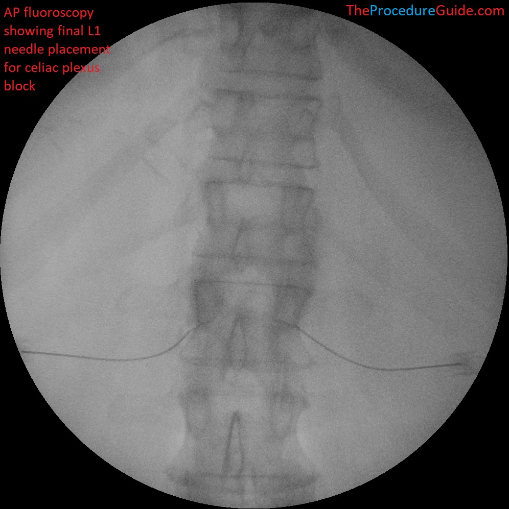 Celiac Plexus Block at L1 - AP fluoroscopy final needle placement