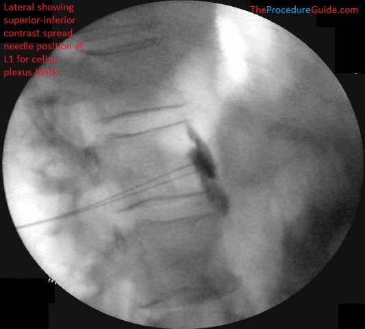 Celiac Plexus Block at L1 - lateral fluoroscopy bilateral final needle placement with contrast spread