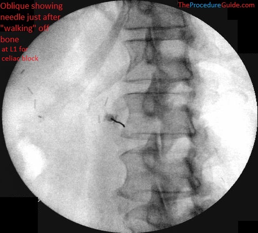 Celiac Plexus Block at L1 - left oblique fluorsocopy initial needle placement