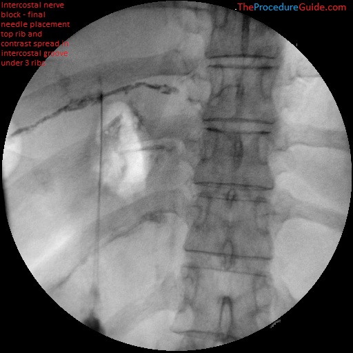 Fluoroscopic intercostal nerve block with contrast spread