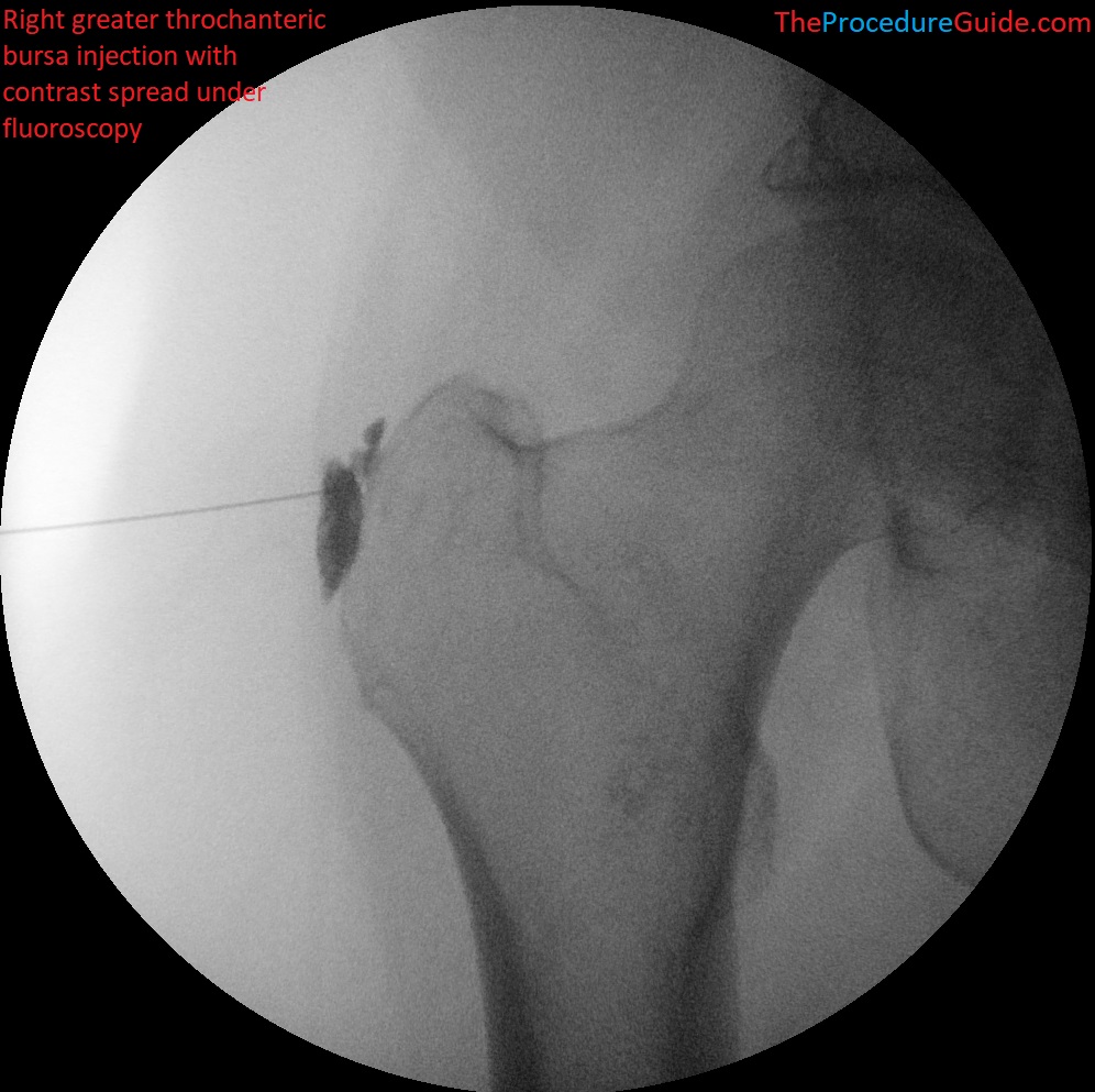 Greater trochanteric bursa injection with contrast under fluoroscopy