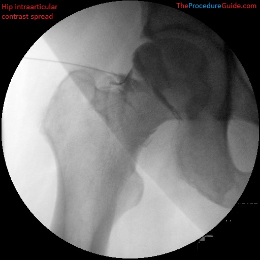 hip intraarticular injection fluoroscopy with contrast