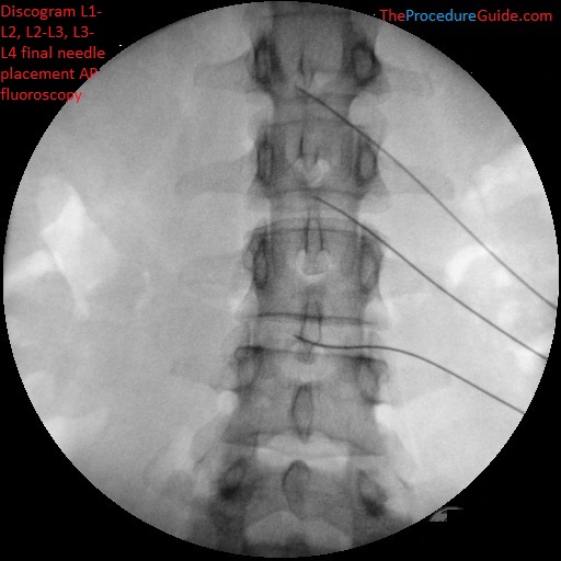 Lumbar discography L1-L2, L2-L3, L3-L4 AP fluoroscopy final needle placement without contrast