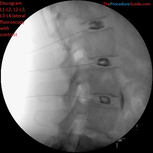 Lumbar discography L1-L2, L2-L3, L3-L4 lateral fluoroscopy with contrast final needle placement