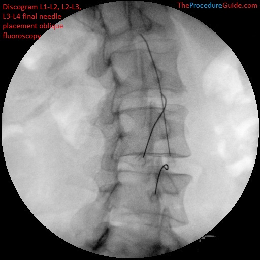 Lumbar discography L1-L2, L2-L3, L3-L4 oblique fluoroscopy final needle placement