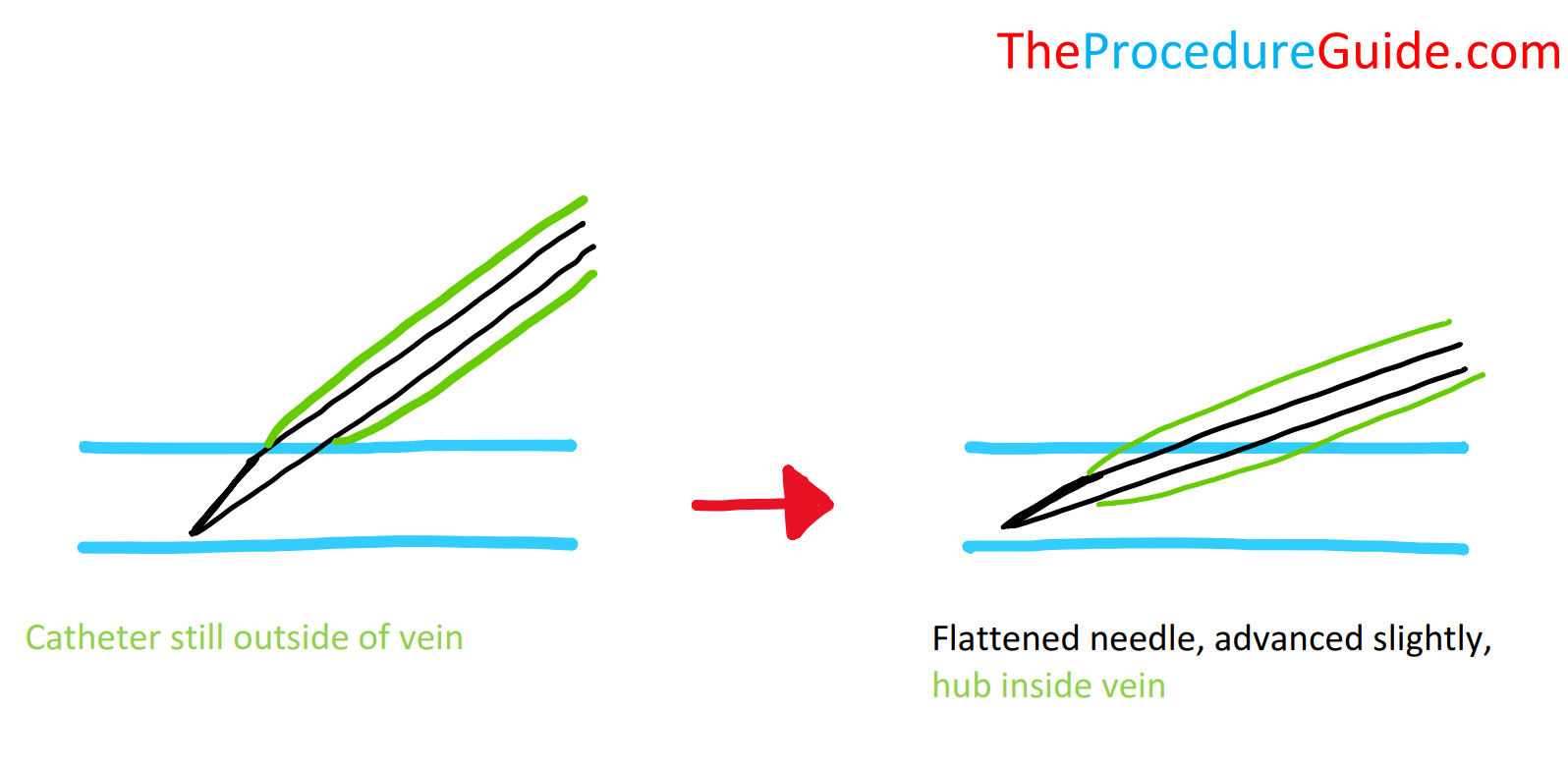 Peripheral IV insertion with needle tip and hub inside vein