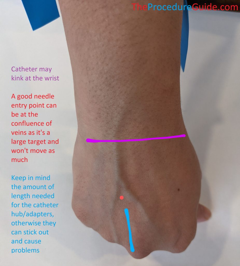 Peripheral IV site selection and considerations