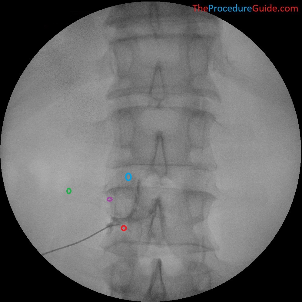 Which color is the appropriate target for your needle?