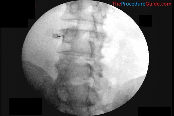What level (vertebrae) is being targeted in this image?