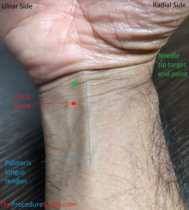 Carpal Tunnel Injection - Everything You Need To Know - Dr. Nabil