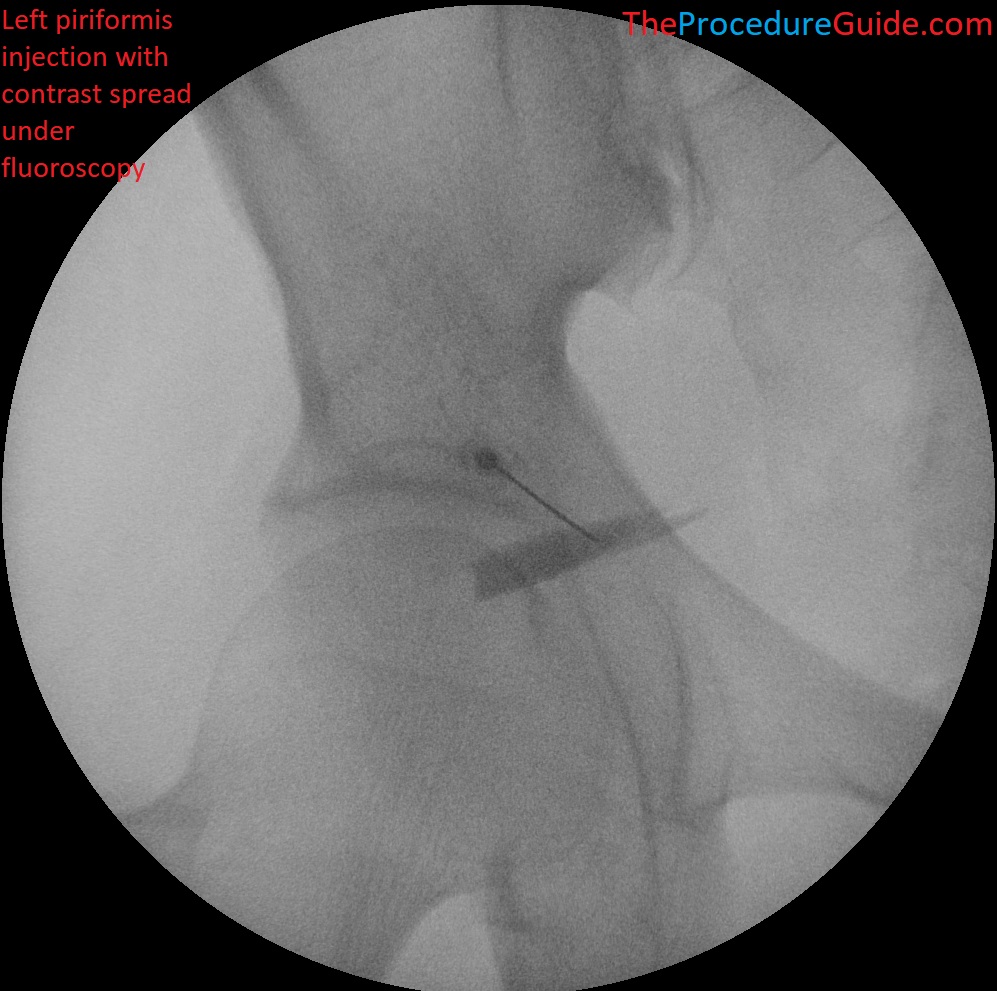 Fluoroscopic guided piriformis injection with contrast spread