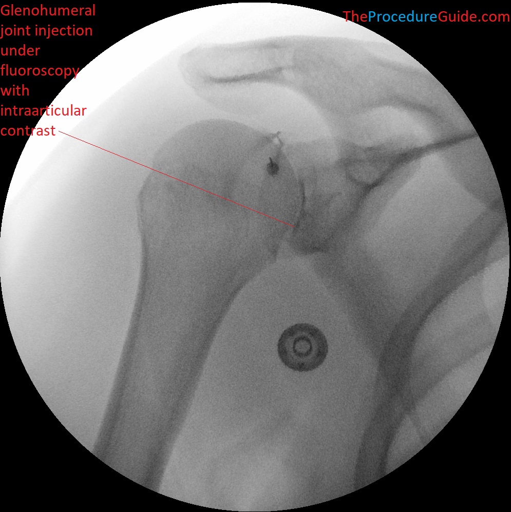 Fluoroscopic guided glenohumeral joint injection with contrast