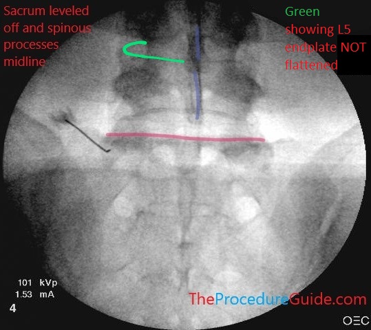 lumbar-medial-branch-block-anterior-posterior-fluoroscopy-alignment-incorrect-example