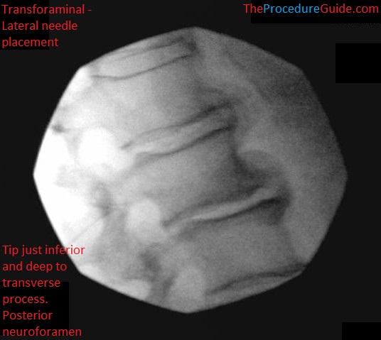 Fluoroscopic Guided Thoracic Lumbar Transforaminal Epidural Steroid Injection Technique And