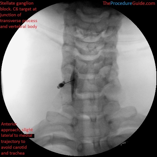 Stellate ganglion block with contrast at C6 under fluoroscopy