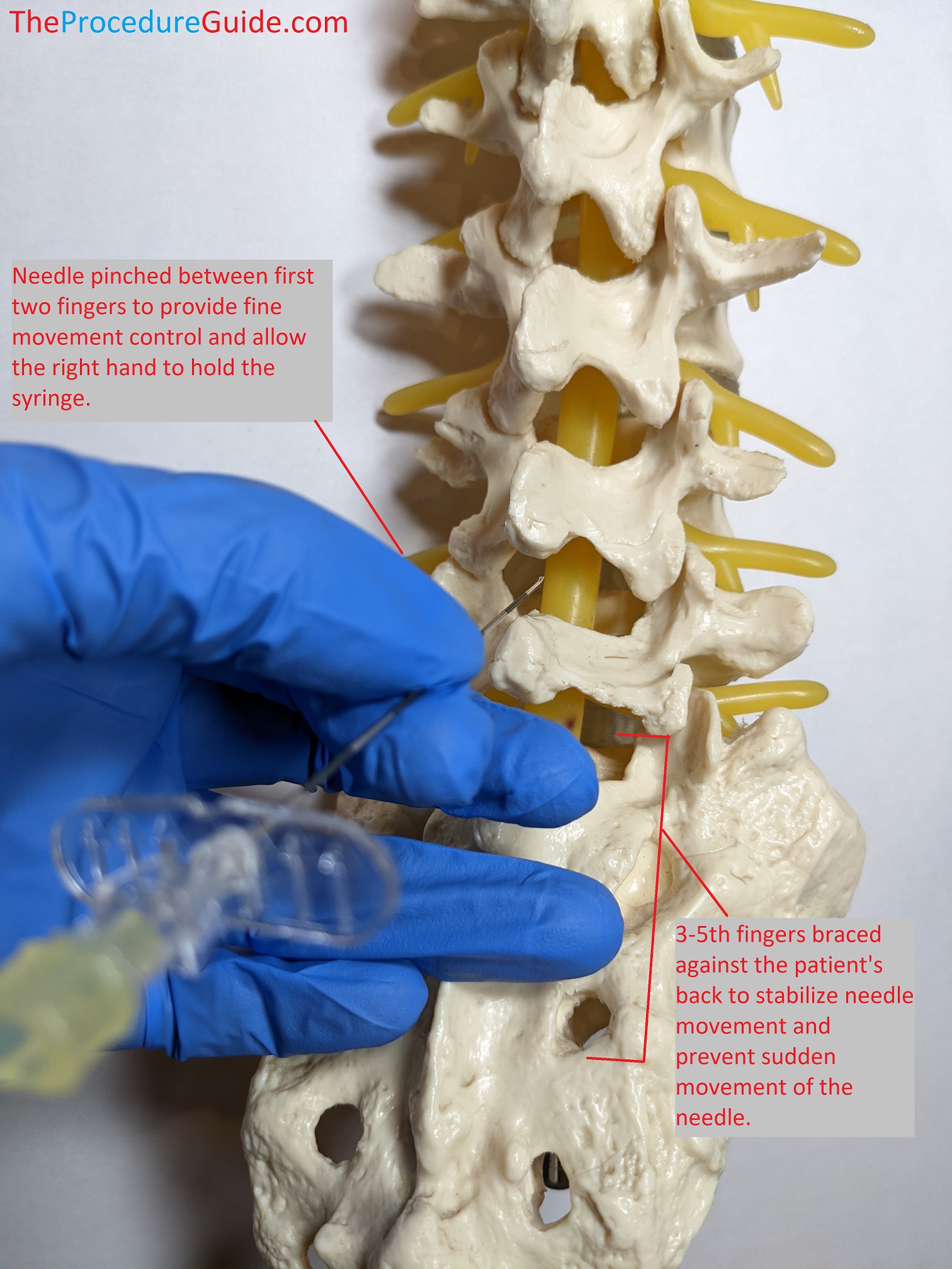 Lumbar/Thoracic Epidural Catheter Insertion Technique and Overview