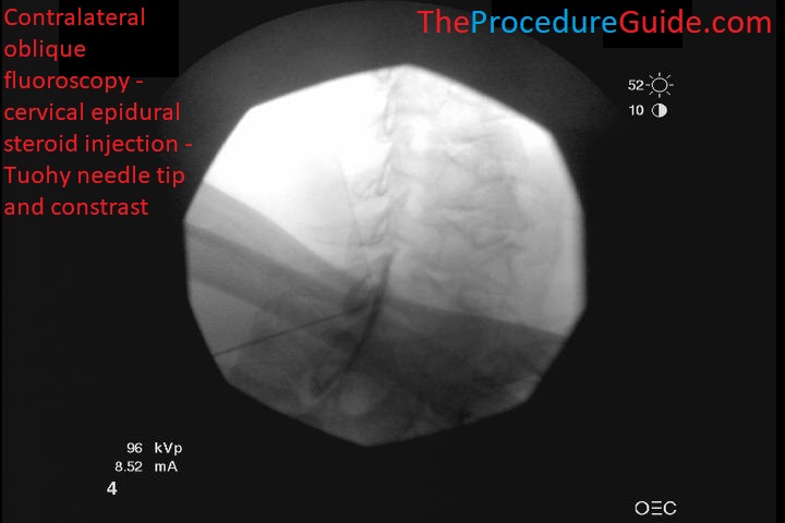 Contralateral Oblique Cervical Epidural Steroid Injection - contralateral oblique fluoroscopy view needle in epidural space with contrast spread