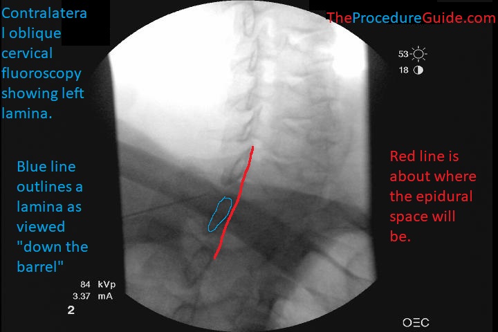 Contralateral Oblique Cervical Epidural Steroid Injection - contralateral oblique fluoroscopy view - with epidural line