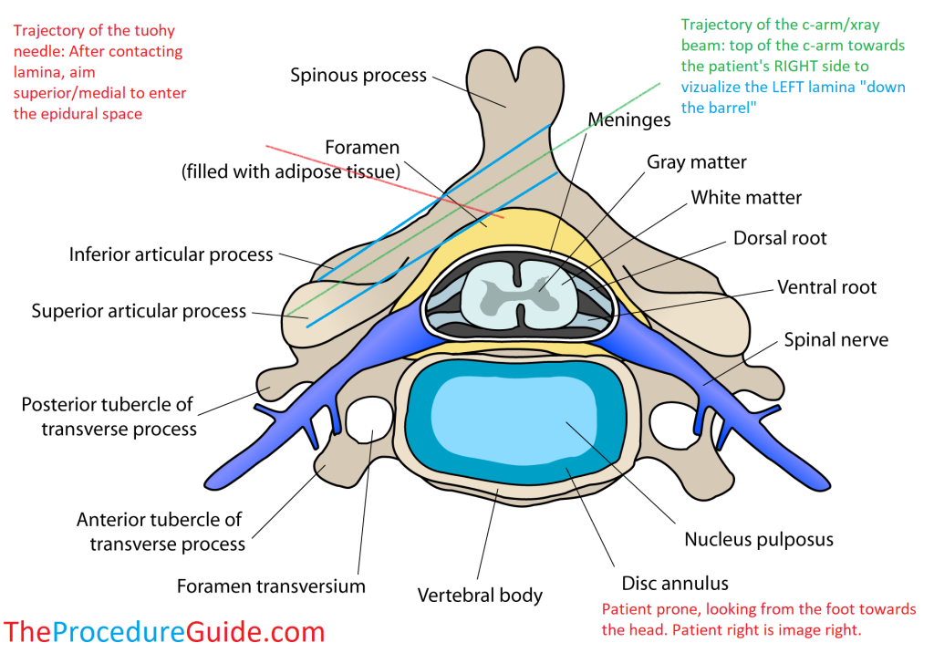 cervical vertebrae transverse - cervical epidural injection - contralateral oblique diagram