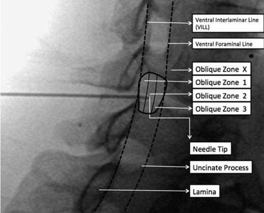 Fluoroscopic Guided Contralateral Oblique Cervical Interlaminar Epidural Steroid Injection